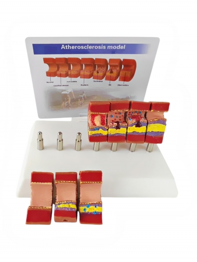 Разборная анатомическая модель атеросклероза сосуда Corpo de Atherosclerosis-2
